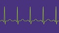 Electrocardiogram ECG displaying sinus tachycardia, 3D illustration
