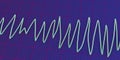 Electrocardiogram ECG displaying Torsades de pointes rhythm, 3D illustration