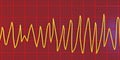 Electrocardiogram ECG displaying Torsades de pointes rhythm, 3D illustration