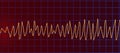 Electrocardiogram ECG displaying Torsades de pointes rhythm, 3D illustration