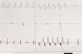 Electrocardiogram ECG / EKG with cardiac arrhythmia Royalty Free Stock Photo