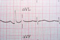 Electrocardiogram ECG in a graph paper shows normal Sinus rhythm, Vital signs and medical healthcare symbol