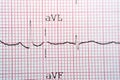 Electrocardiogram ECG in a graph paper shows normal Sinus rhythm, Vital signs and medical healthcare symbol Royalty Free Stock Photo