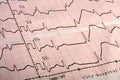 Electrocardiogram ECG printout