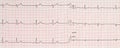 Electrocardiogram example of a normal 12-lead sinus rhythm