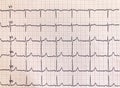 Electrocardiogram hospital examination. Sheet that represents a diagnostic test Royalty Free Stock Photo