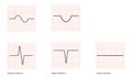 Electrocardiogram