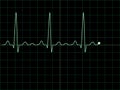 Electrocardiogram on an oscilloscope