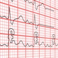 Electrocardiogram Pounds