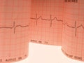 Electrocardiogram printout detail over a white table