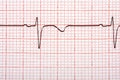 Electrocardiogram Printout