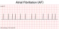 Electrocardiogram show Atrial fibrillation AF. Royalty Free Stock Photo