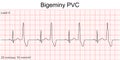 Electrocardiogram show Bigeminy PVC pattern.
