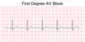 Electrocardiogram show first degree AV block pattern.