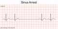 Electrocardiogram show Sinus arrest pattern.