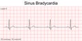 Electrocardiogram show Sinus bradycardia pattern. Royalty Free Stock Photo