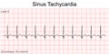 Electrocardiogram show Sinus tachycardia pattern.