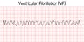 Electrocardiogram show ventricular fibrillation VF pattern.