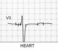 Electrocardiogram test that shows electrical activity of the heart