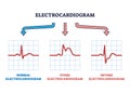 Electrocardiogram STEMI and NSTEMI abnormal heart rate outline diagram Royalty Free Stock Photo