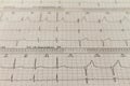 Electrocardiogram strips with cardiac arrhythmias. Ventricular escape beat. Selective focus on some beats. Free space to write