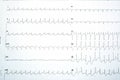 Electrocardiogram test results for myocardial ischemia diagnosis Royalty Free Stock Photo