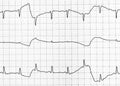 Electrocardiogram test that shows electrical activity of the heart