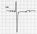Electrocardiogram test that shows electrical activity of the heart