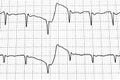 Electrocardiogram test that shows electrical activity of the heart