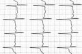 Electrocardiogram test that shows electrical activity of the heart