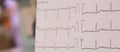 Electrocardiogram for detected abnormal heart rate in the patients who has clinical chest pain in the emergency room in hospital.