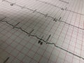 ECG