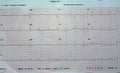 An ElectroCardioGraph ECG, a chart that draws the electricity of the heart and gives an idea on the heart condition and the rhythm