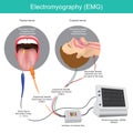 Electromyography. A technique medical.