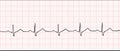 Electronic cardiogram