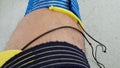 Electrostimulation of the quadriceps as a physiotherapy therapy