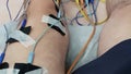 Electrostimulation of the quadriceps as a physiotherapy therapy