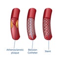 Elimination Atherosclerosis Realistic Presentation