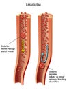 Embolism