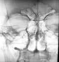 Embolization pavermian thrombosed aneurism scan
