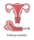 Embryo transfer into a woman's uterus at In Vitro fertilization