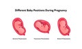 Embryo in womb medical diagram. Vector flat healthcare illustration. Different baby position during pregnancy. Anterior,