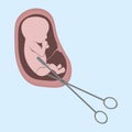 An embryo in the womb and surgical scissors. Abortion is a personal decision of each person. Flat vector illustration