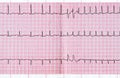 ECG with supraventricular extrasystole and short paroxysm of atrial fibrillation Royalty Free Stock Photo