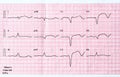 ECG with acute period of large-focal widespread anterior myocardial infarction