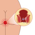 Emorrhoids on anal blood focus thrombosis, illustration on white background