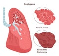 Emphysema. Chronic obstructive pulmonary disease caused by smoking.