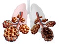Emphysema Disease Royalty Free Stock Photo