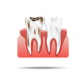 Enamel Caries Infection and Health Tooth Realistic Pulpitis. Stomatology Health Care.