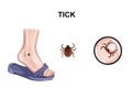 Encephalitis tick bite